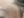 皮下分离术（Subcision，痘坑松解） — 术后 (60天) · The Ollim医美诊所