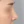 ผ่าตัดเอาสิ่งแปลกปลอมออกจากจมูก (เอาซิลิโคนจมูกออก) — หลังทำ (30วัน) · คลินิกศัลยกรรมพลาสติก ABEC