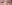 裏ハムラ法（経結膜的眼窩脂肪移動術） — プレジャー美容外科クリニック