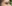裏ハムラ法（経結膜的眼窩脂肪移動術） — アンド美容外科クリニック