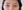 Insulated RF microneedle acne treatment (Agnes) — after (30days) · Remiel Plastic Surgery Clinic