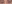 裏ハムラ法（経結膜的眼窩脂肪移動術） — イエロー美容外科クリニック
