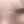 acne scar subcision / regenerative needling — before (120days) · Rodam Korean Medicine Clinic - Jamsil Branch