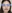 Marionette line filler — Skyline Clinic