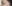 Brow lift — Urban Plastic Surgery Clinic
