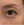 Eyelid filler (upper eyelid hollowing correction) — before (14days) · Wow Plastic Surgery
