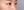 Insulated RF microneedle acne treatment (Agnes) — before (30days) · Remiel Plastic Surgery Clinic