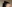 Forehead reduction (hairline lowering surgery) — Uri Plastic Surgery Clinic