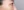 Insulated RF microneedle acne treatment (Agnes) — after (30days) · Remiel Plastic Surgery Clinic