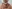 Double chin liposuction (submental liposuction) — Uri Plastic Surgery Clinic