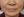 JUVGEN (autologous dermal regeneration / collagen-induction injection) — before (14days) · Saeroun Plastic Surgery