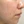 Rejuran S (รีจูรัน S กล่องน้ำเงิน — หลุมสิว/แผลเป็น) — หลังทำ (14วัน) · คลินิก U