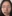 Nasal dorsum augmentation with implant (silicone/Gore-Tex) — Cheotdanbu Clinic
