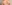 二の腕の脂肪吸引 — ソウル童顔クリニック