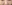 裏ハムラ法（経結膜的眼窩脂肪移動術） — アンド美容外科クリニック