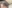 額縮小術（生え際下げ・ヘアライン下降術） — バタン美容外科クリニック