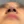 Nose tip filler — after · Erne Clinic