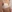 豊胸術（シリコンインプラント／人工乳腺） — バナナ美容外科クリニック