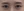 incisional double eyelid surgery — before (7days) · iLumi Plastic Surgery Clinic