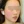 麗珠蘭（Rejuran Healer） — 術後 · View Level醫美診所