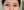 Insulated RF microneedle acne treatment (Agnes) — before (30days) · Remiel Plastic Surgery Clinic
