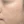 Chemical peel — after (35days) · J.Fill Clinic - Gangnam Branch