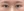 incisional double eyelid surgery — after (7days) · iLumi Plastic Surgery Clinic