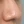 Chemical peel — before (28days) · J.Fill Clinic - Gangnam Branch