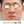 ウルセラプライム（Ultherapy PRIME） — 術後 · モンスタークリニック