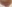 唇のヒアルロン酸注入（リップヒアルロン酸） — ソウル童顔クリニック