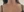 เลเซอร์สลายไขมันต้นขา — ก่อนทำ (60วัน) · คลินิกหมอซนยูนา