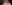 buried suture (non-incisional) double eyelid surgery — 1mm Plastic Surgery