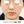 ウルセラプライム（Ultherapy PRIME） — 術後 · モンスタークリニック