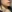 Corner lip lift (mouth corner lift) — Like Plastic Surgery Clinic