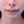 ศัลยกรรมยกริมฝีปากบน (Lip Lift) — หลังทำ (7วัน) · ไฮบอม ศัลยกรรมพลาสติก