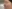 隆鼻術（シリコンプロテーゼ） — ザ・プライド美容外科クリニック