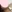 Double chin liposuction (submental liposuction) — Yuno Plastic Surgery