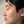 ฉีดลดขนาดจมูกแบบไม่ผ่าตัด (สลายไขมัน+สเตียรอยด์+โบท็อกซ์) — ก่อนทำ · คลินิก U
