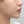 TuneLiner (non-invasive ultrasound fat reduction & contouring) — after (28days) · J.Fill Clinic - Gangnam Branch