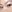 buried suture (non-incisional) double eyelid surgery — Yellow Plastic Surgery Clinic