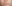 顔の脂肪溶解注射（小顔注射） — O&N美容外科
