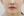 Paranasal (nasal base) augmentation with implant — before (30days) · Apgujeong Lee & Star Clinic