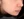 Volnewmer (โวลนิวเมอร์ ยกกระชับด้วย RF) — หลังทำ (21วัน) · คลินิกพาร์ควิว สาขาจัมซิล