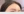 太阳穴自体脂肪填充 — 术后 (21天) · Lively医美诊所