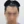 Hairline hair transplant (hairline lowering by grafting) — before (1days) · Vance Mosae Clinic