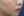 skin booster injection (water glow injection) — after · K-Tox Clinic - Bupyeong Branch