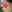 revision rhinoplasty — DM Plastic Surgery Clinic
