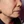 Full-face filler (full-face HA rejuvenation) — before · Project U Clinic