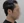 Hairline hair transplant (hairline lowering by grafting) — after (1days) · Vance Mosae Clinic