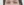 眼睑脂肪填充（上睑凹陷填充） — 术后 (8天) · 高唯医美诊所